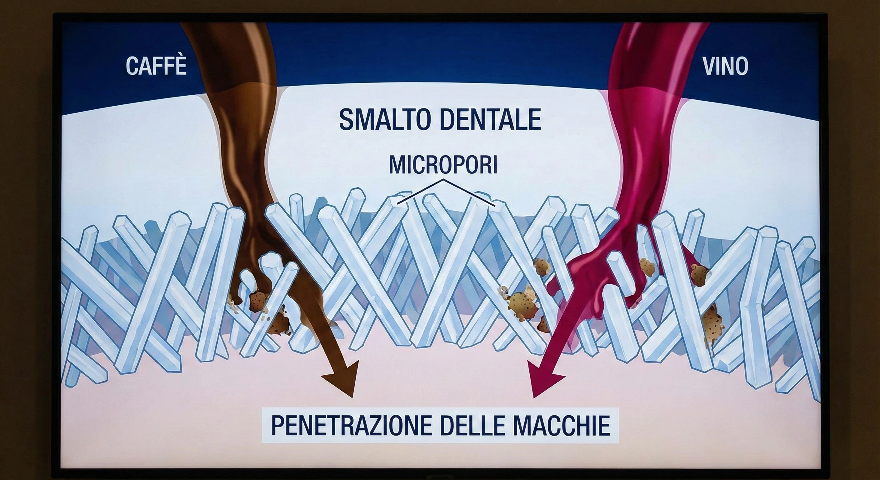 Grafico ingrandito che mostra come le macchie di caffè e vino penetrano nei micropori dello smalto dentale