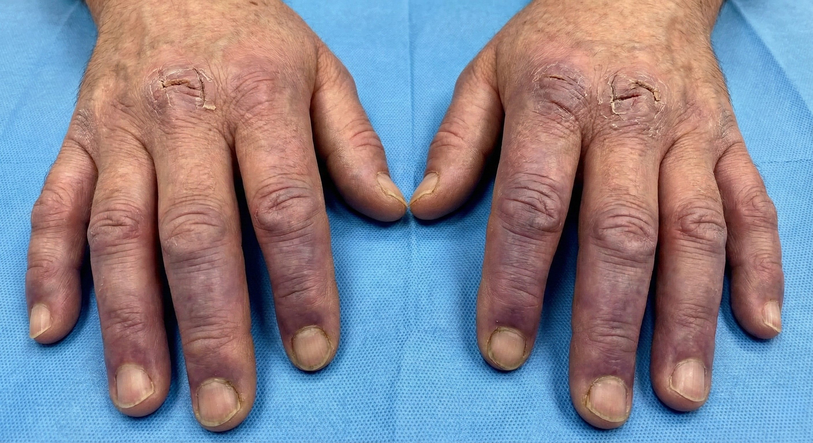 Dettaglio clinico di mani affette da asfissia capillare: dita violacee, gonfie e con ragadi profonde sulle nocche dovute al freddo intenso